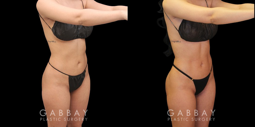 Post-op photos of mid-30s female patient for mini BBL surgery. As a mini BBL, precise liposuction resulting in enhanced body sculpting with a subtle yet marked increase in butt size, shape, and volume. Almost perfectly rounded buttocks resulted after fat settled for the patient's final results. Note the increase in abdominal contour from front and side views.