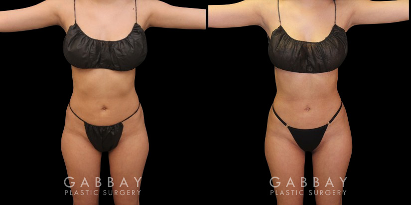 Post-op photos of mid-30s female patient for mini BBL surgery. As a mini BBL, precise liposuction resulting in enhanced body sculpting with a subtle yet marked increase in butt size, shape, and volume. Almost perfectly rounded buttocks resulted after fat settled for the patient's final results. Note the increase in abdominal contour from front and side views.