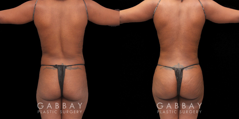 Multiple views of African-American female patient before and after combined liposuction and 360 lipo. Patient’s waist has notable slimming and contouring that enhances the fullness of the buttock. With the butt lift injections, the top position of the butt appears higher, resulting in a rounder curve with a more pronounced gluteal shape.