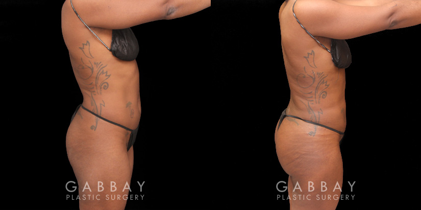 Multiple views of African-American female patient before and after combined liposuction and 360 lipo. Patient’s waist has notable slimming and contouring that enhances the fullness of the buttock. With the butt lift injections, the top position of the butt appears higher, resulting in a rounder curve with a more pronounced gluteal shape.