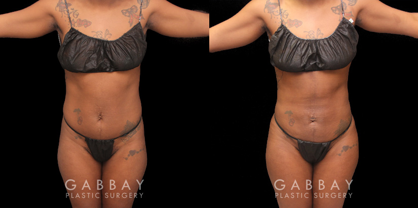 Multiple views of African-American female patient before and after combined liposuction and 360 lipo. Patient’s waist has notable slimming and contouring that enhances the fullness of the buttock. With the butt lift injections, the top position of the butt appears higher, resulting in a rounder curve with a more pronounced gluteal shape.