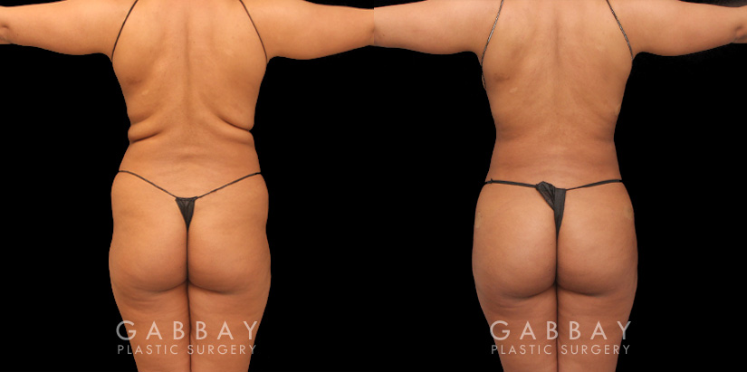 Female patient with 360 liposuction and skin tightening with fat transfer to buttocks, creating a slimmer appearance with a well-rounded butt.