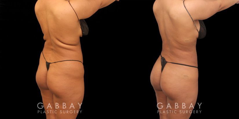 Female patient with 360 liposuction and skin tightening with fat transfer to buttocks, creating a slimmer appearance with a well-rounded butt.