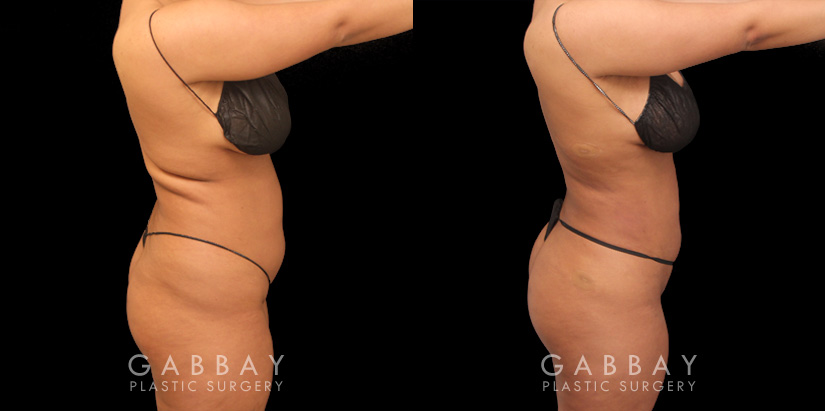 Female patient with 360 liposuction and skin tightening with fat transfer to buttocks, creating a slimmer appearance with a well-rounded butt.