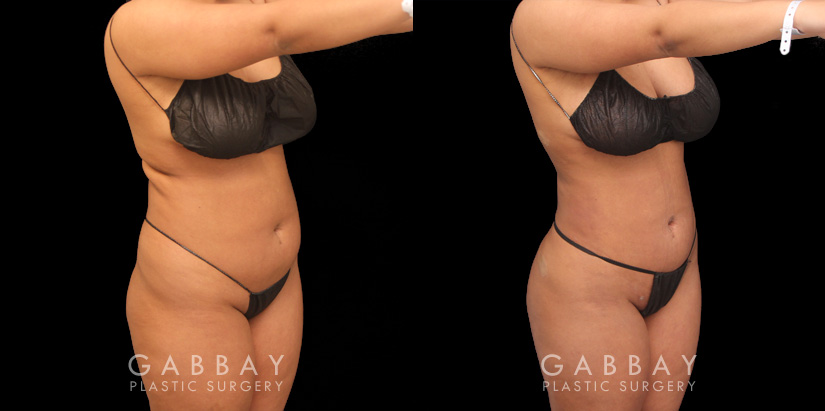 Female patient with 360 liposuction and skin tightening with fat transfer to buttocks, creating a slimmer appearance with a well-rounded butt.