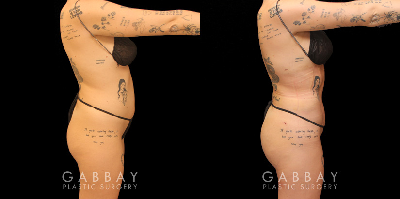 Female patient before and after BBL surgery combined with 360 liposuction. Slimmer waist and enhanced roundness of butt produced an impressive figure and silhouette from all angles.