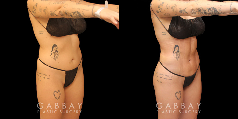 Female patient before and after BBL surgery combined with 360 liposuction. Slimmer waist and enhanced roundness of butt produced an impressive figure and silhouette from all angles.