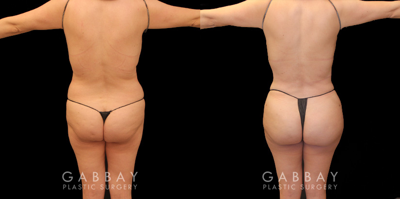 Effective liposuction combined with butt lift surgery enhanced patient’s body shape, shifting it from a more rectangular shape to a rounder, fuller shape with curves.