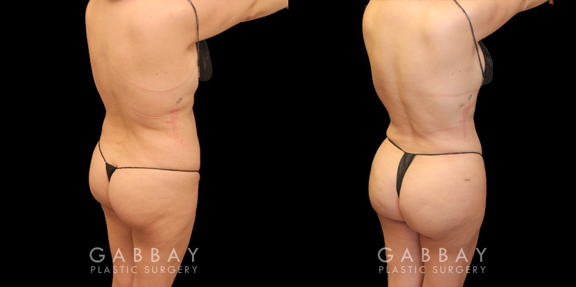 Effective liposuction combined with butt lift surgery enhanced patient’s body shape, shifting it from a more rectangular shape to a rounder, fuller shape with curves.