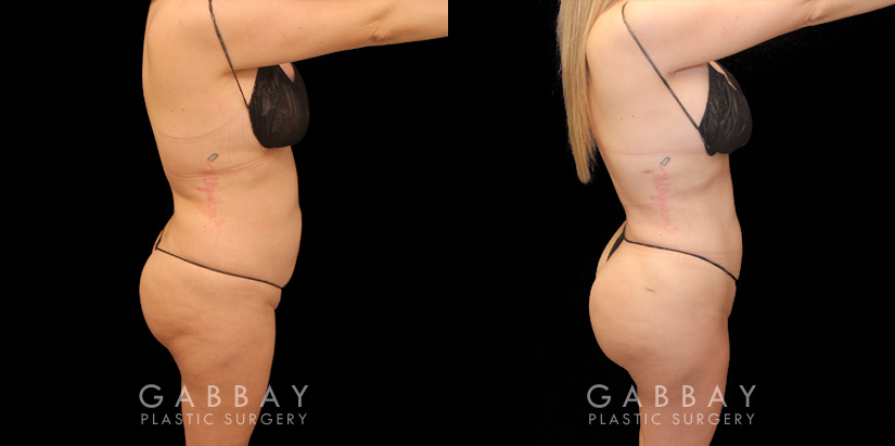 Effective liposuction combined with butt lift surgery enhanced patient’s body shape, shifting it from a more rectangular shape to a rounder, fuller shape with curves.
