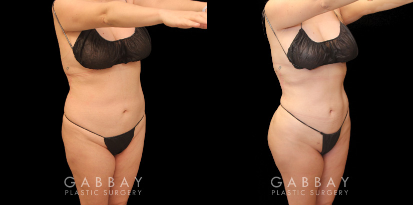 Effective liposuction combined with butt lift surgery enhanced patient’s body shape, shifting it from a more rectangular shape to a rounder, fuller shape with curves.