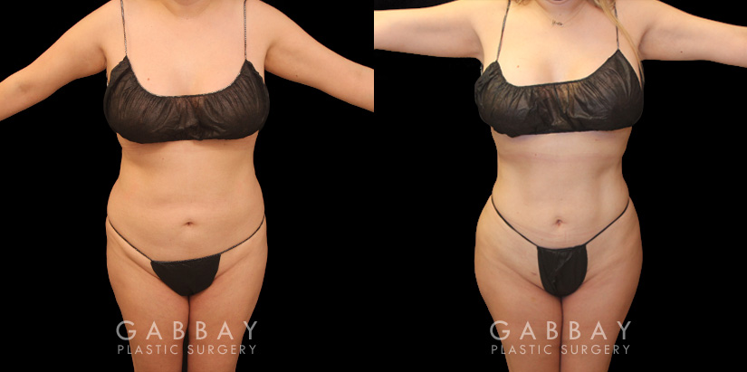 Effective liposuction combined with butt lift surgery enhanced patient’s body shape, shifting it from a more rectangular shape to a rounder, fuller shape with curves.
