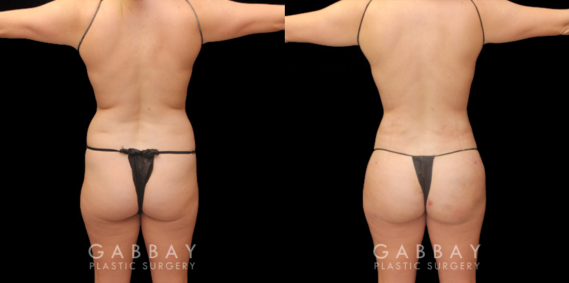 BBL post-op results showing well-settled butt injections for a mild increase in volume and enhancement of overall shape. 360 liposuction of the waist emphasizes the hourglass shape of the body and a natural-looking, slimmer silhouette. All post-op visits showed recovery without complications.