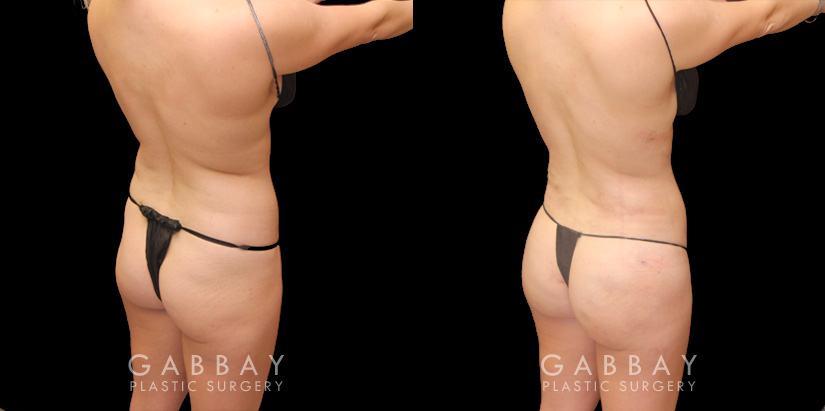 Brazilian Butt Lift Before and After Photo Gallery