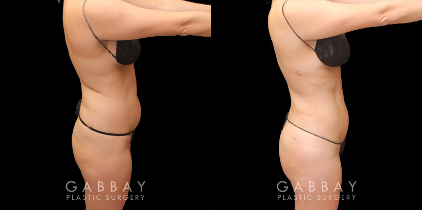 BBL post-op results showing well-settled butt injections for a mild increase in volume and enhancement of overall shape. 360 liposuction of the waist emphasizes the hourglass shape of the body and a natural-looking, slimmer silhouette. All post-op visits showed recovery without complications.
