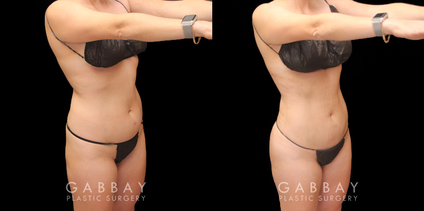 BBL post-op results showing well-settled butt injections for a mild increase in volume and enhancement of overall shape. 360 liposuction of the waist emphasizes the hourglass shape of the body and a natural-looking, slimmer silhouette. All post-op visits showed recovery without complications.
