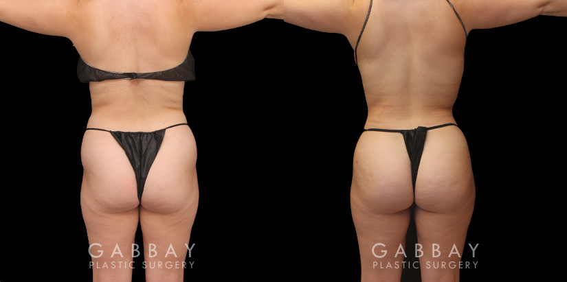 Female patient results with before-and-after of Brazilian butt lift surgery combined with liposuction of the abdomen and waist. Targeted mild volume increase with a focus on creating a rounder butt shape and filling in of her hip dips with gentler liposuction to maintain a natural body shape with smoother contours while also tightening abs and waist. This BBL was done under local anesthesia with the patient awake and comfortable. She had a comfortable and easy recovery.