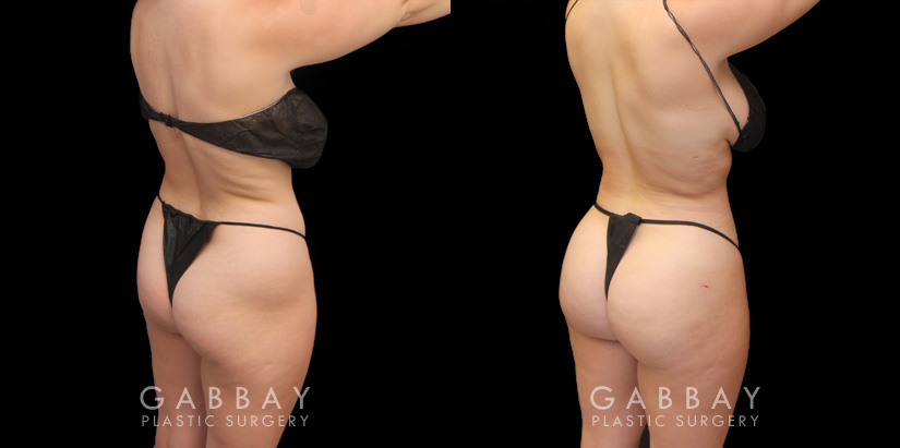 Female patient results with before-and-after of Brazilian butt lift surgery combined with liposuction of the abdomen and waist. Targeted mild volume increase with a focus on creating a rounder butt shape and filling in of her hip dips with gentler liposuction to maintain a natural body shape with smoother contours while also tightening abs and waist. This BBL was done under local anesthesia with the patient awake and comfortable. She had a comfortable and easy recovery.