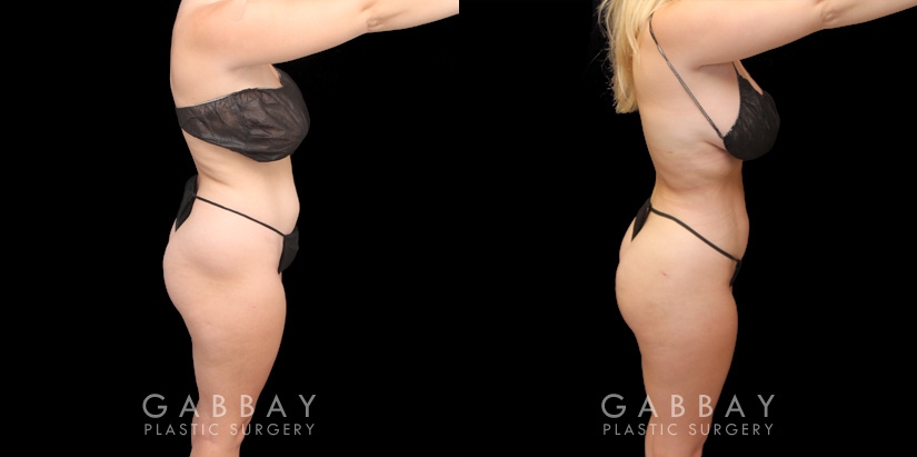 Female patient results with before-and-after of Brazilian butt lift surgery combined with liposuction of the abdomen and waist. Targeted mild volume increase with a focus on creating a rounder butt shape and filling in of her hip dips with gentler liposuction to maintain a natural body shape with smoother contours while also tightening abs and waist. This BBL was done under local anesthesia with the patient awake and comfortable. She had a comfortable and easy recovery.