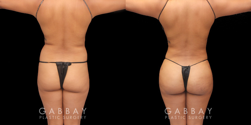 Patient 10Before and after results of fat transfer to butt for female patient. BBL surgery that took fat via liposuction from the abdomen, flanks, and waist with lipo 360 methodology, transferring fat injections to buttocks for a contoured body and plump round buttocks with lifted position for sportier body shape..Back Side View Brazilian Butt Lift Gabbay Plastic Surgery