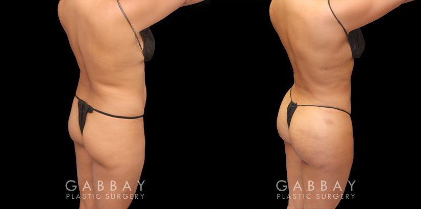 Before and after results of fat transfer to butt for female patient. BBL surgery that took fat via liposuction from the abdomen, flanks, and waist with lipo 360 methodology, transferring fat injections to buttocks for a contoured body and plump round buttocks with lifted position for sportier body shape..