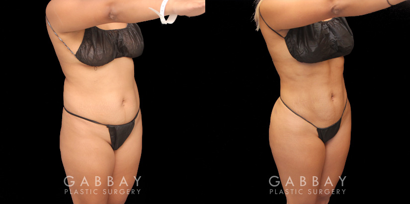 Before and after results of fat transfer to butt for female patient. BBL surgery that took fat via liposuction from the abdomen, flanks, and waist with lipo 360 methodology, transferring fat injections to buttocks for a contoured body and plump round buttocks with lifted position for sportier body shape..