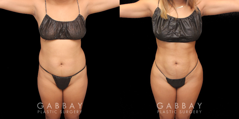 Before and after results of fat transfer to butt for female patient. BBL surgery that took fat via liposuction from the abdomen, flanks, and waist with lipo 360 methodology, transferring fat injections to buttocks for a contoured body and plump round buttocks with lifted position for sportier body shape..