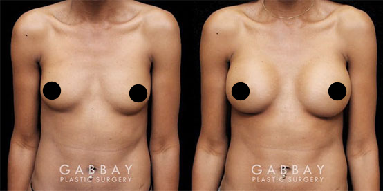 Patient 01 Front View Breast Augmentation with Lift Before and After Gabbay Plastic Surgery