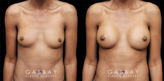 Patient 01 Front View Breast Augmentation with Lift Before and After Gabbay Plastic Surgery