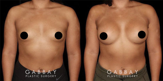 Patient 02 Front View Breast Augmentation with Lift Before and After Gabbay Plastic Surgery