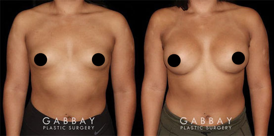 Breast Augmentation Beverly Hills