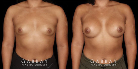 Patient 02 Front View Breast Augmentation with Lift Before and After Gabbay Plastic Surgery