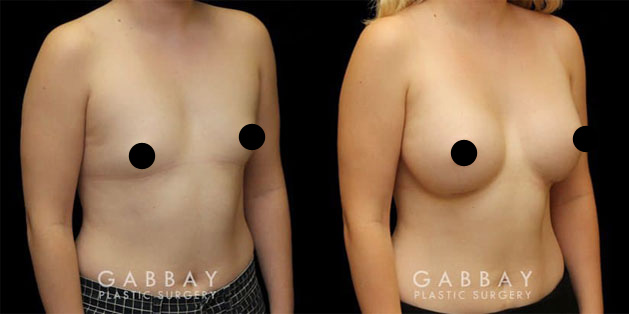 Patient 03 3/4th Right Side View Breast Augmentation with Lift Before and After Gabbay Plastic Surgery