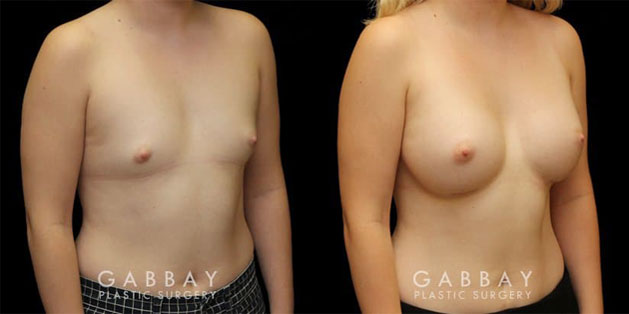 Patient 03 3/4th Right Side View Breast Augmentation with Lift Before and After Gabbay Plastic Surgery