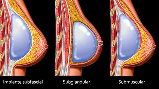 Breast Implant Placement Information Dr Gabbay, subfacial impant, subglandular implant, subpectoral implant
