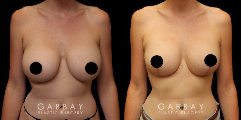 Patient 04 Front View Breast Lift Before and After Gabbay Plastic Surgery