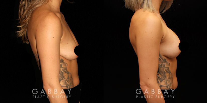Breast Lift Before and After Patient 02 Right Side View