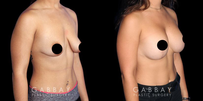 Breast Lift Before and After Patient 01 3/4th Right Side View Gabbay Plastic Surgery