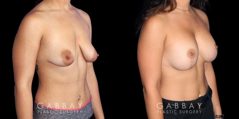 Breast Lift Before and After Patient 01 3/4th Right Side View Gabbay Plastic Surgery