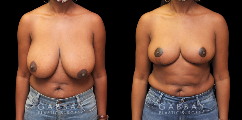 Patient 06 Front View Breast Reduction with Lift Gabbay Plastic Surgery