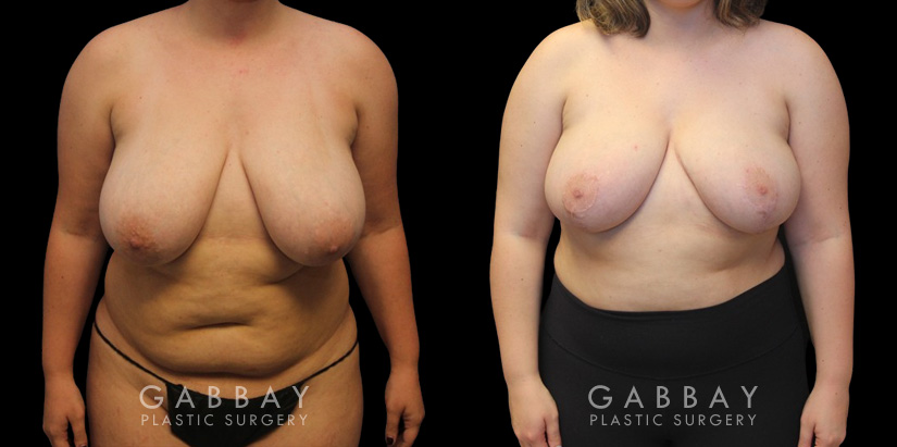 Patient 07 Front View Breast Reduction with Lift Gabbay Plastic Surgery