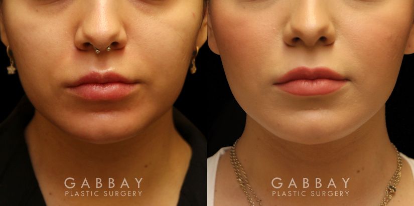 Patient 03 Front View Buccal Fat Removal Before and After Gabbay Plastic Surgery