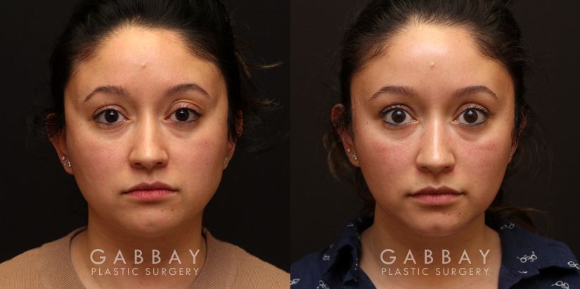 Patient 02 Front View Buccal Fat Removal Before and After Gabbay Plastic Surgery