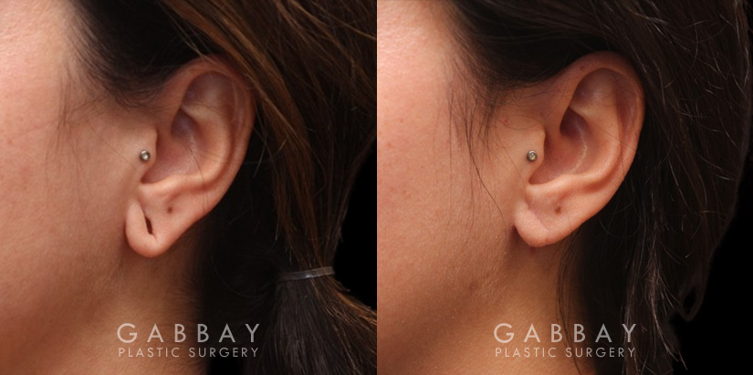 Patient 06 Left Side View Earlobe Repair Gabbay Plastic Surgery