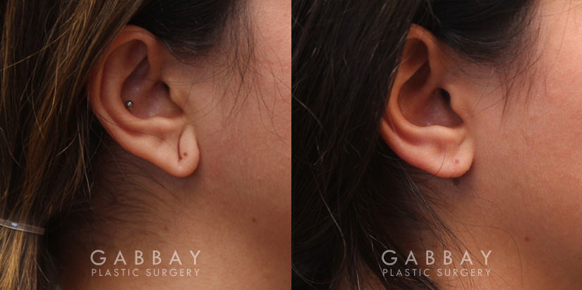 Patient 06 Right Side View Earlobe Repair Gabbay Plastic Surgery