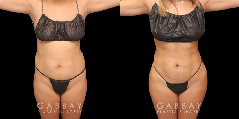 Full 360 view of patient following liposuction surgery focusing on removing belly fat, fat around the waist, and tailbone fat for a contoured result from every angle.