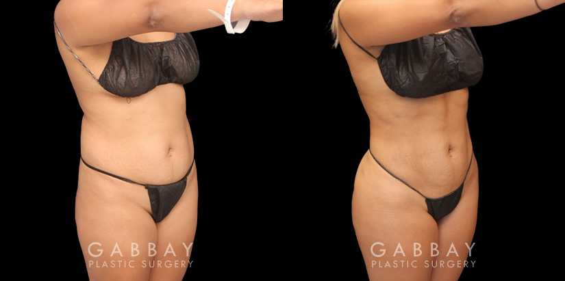 Full 360 view of patient following liposuction surgery focusing on removing belly fat, fat around the waist, and tailbone fat for a contoured result from every angle.