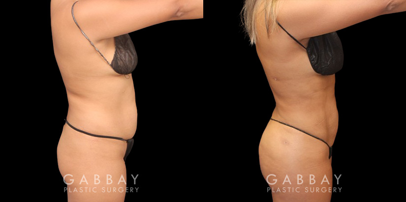 Full 360 view of patient following liposuction surgery focusing on removing belly fat, fat around the waist, and tailbone fat for a contoured result from every angle.