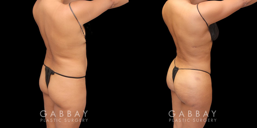 Full 360 view of patient following liposuction surgery focusing on removing belly fat, fat around the waist, and tailbone fat for a contoured result from every angle.