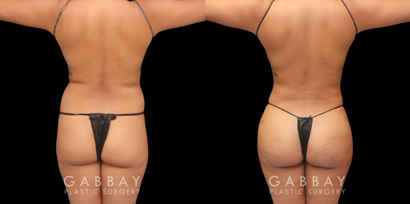 Full 360 view of patient following liposuction surgery focusing on removing belly fat, fat around the waist, and tailbone fat for a contoured result from every angle.